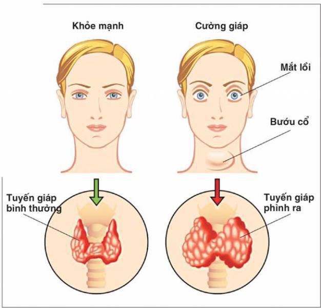 ảnh mô phỏng một người bị cường giáp, bướu cổ