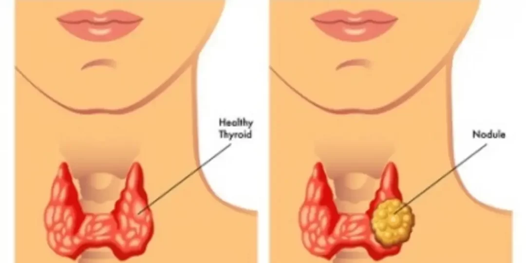 bệnh u tuyến giáp -thyroid_nodule_image