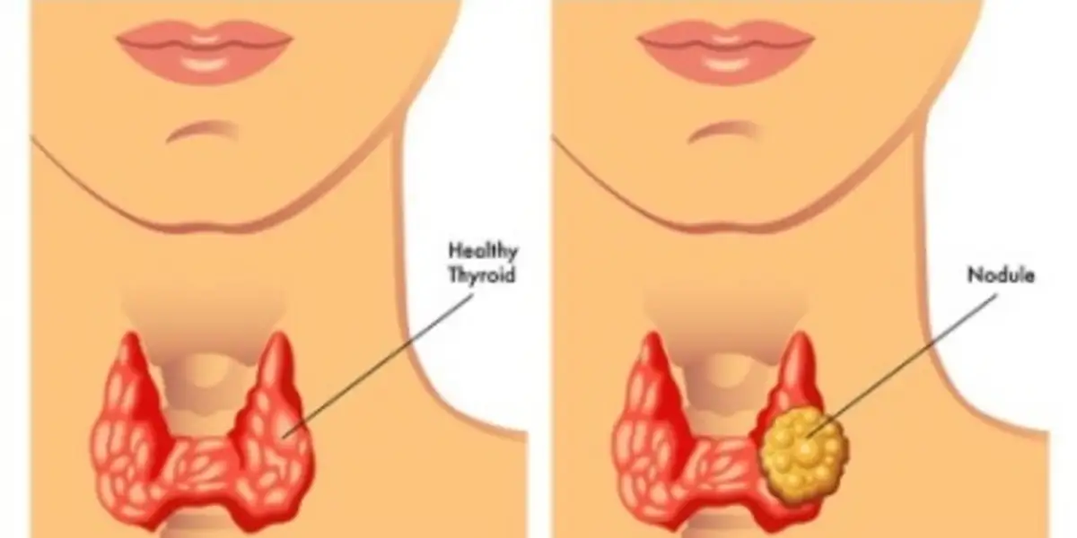 bệnh u tuyến giáp -thyroid_nodule_image