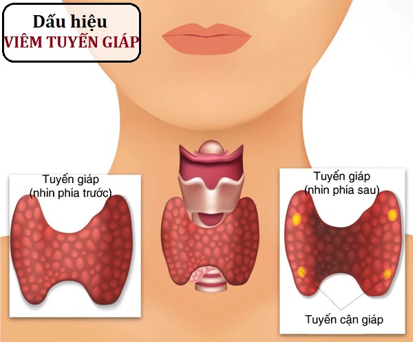 bệnh viêm tuyến giáp